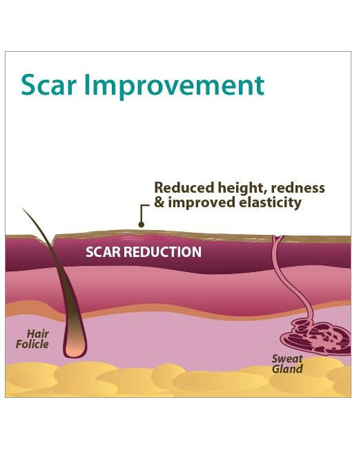 Biodermis Epi-Derm Silicone Gel C-Strip 1.25"x5.75" - Clear Gel (5 Strip per Package)