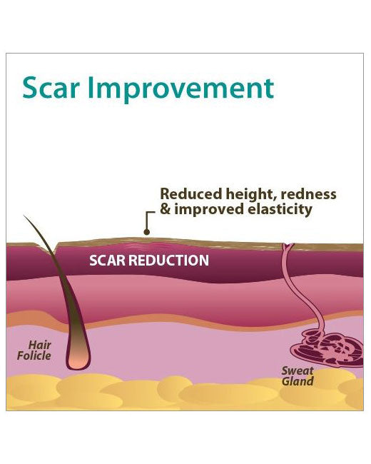 Biodermis Epi-Derm Silicone Gel Standard Sheet 4.7" x 5.7" - Clear Gel - 5 sheets per package