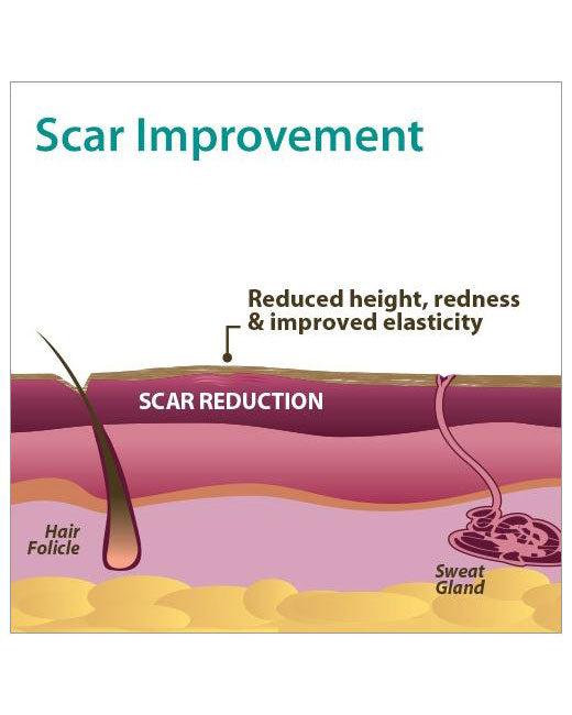 Biodermis Pro-Sil Silicone Scar Stick 4.25gm  - 1 each